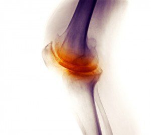 bone disease osteoarthritis pain
