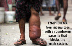 lymphedema from mosquitoes that blocks lymph system