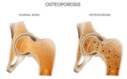 Bigstock osteoporosis 44323384