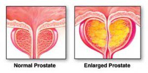 enlargedprostatetreatment