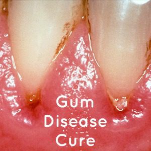 Gum Disease Cure by Flickr AJC11