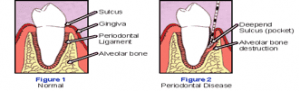 Teeth Plaque