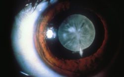 Cataract by flickr community eye health