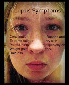 Pain Lupus symptoms by flickr Phoney Nickle