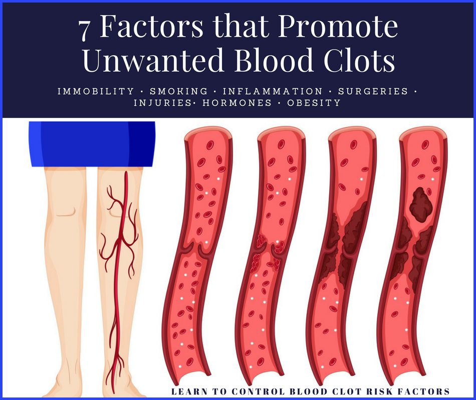 Tips for Blood Clot Prevention | Home Cures That Work