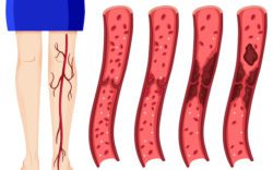 640 bigstock blood clot in human legs illus 135637568
