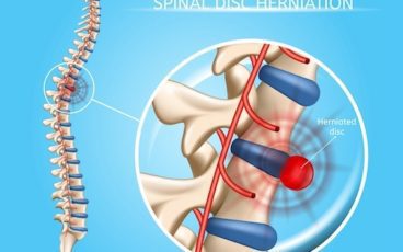427 bigstock spinal disk herniation vector 249050917